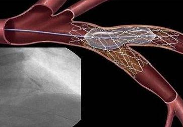 血管支架微孔结构激光切割工艺介绍